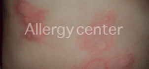 Urticaire-aigue-par-allergie-à-l’aspirine- Urticaire-aigue-par-allergie-à-l’aspirine-