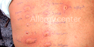 Allergie-au-cefaloject Allergie-au-cefaloject