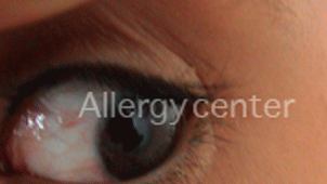 Allergie aux poils de chat