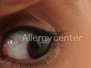 Allergie-aux-poils-de-chat Allergie aux poils de chat