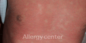 Allergie-aux-produits-de-contraste