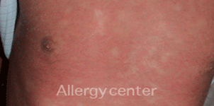 Allergie-aux-produits-de-contraste Allergie-aux-produits-de-contraste