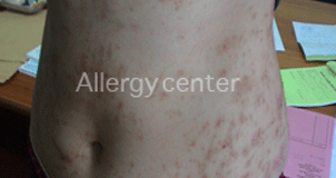 Allergie-retardée-à-l’augmentin Allergie-retardée-à-l’augmentin