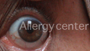 Conjonctivite allergique