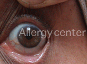 Conjonctivite allergique