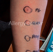 allergycenter