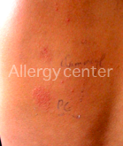 allergycenter