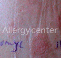 allergycenter