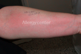 allergycenter