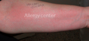 allergycenter