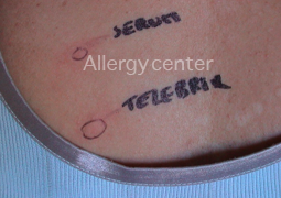 allergycenter