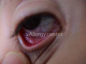 allergycenter