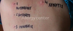 allergycenter