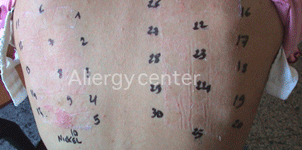 Patch-tests-positifs-au-nickel- Patch-tests-positifs-au-nickel