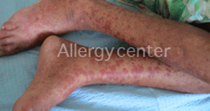 Purpura-immuno-allergique- Purpura-immuno-allergique