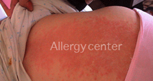 Réaction-allergique- Réaction-allergique