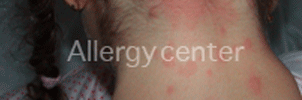 Urticaire-aigue-par-allergie-à-l’aspirine- Urticaire-aigue-par-allergie-à-l’aspirine-