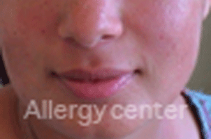 alergy-center