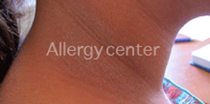 alergy-center