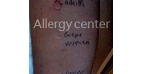 allergie-aux-venins-d’hymenopteres