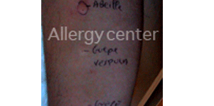 allergie-aux-venins-d’hymenopteres allergie-aux-venins-d’hymenopteres