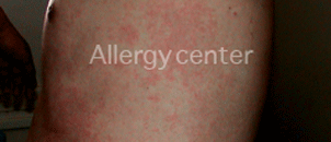 allergies-alimentaires