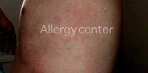 allergies-alimentaires