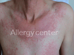 allergies-medicamenteuses