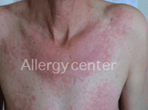 allergies-medicamenteuses allergies-medicamenteuses