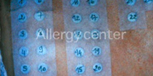 eczema eczema