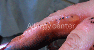 eczémas-de-contact eczémas-de-contact