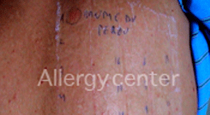 allergycenter