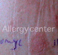 allergy center